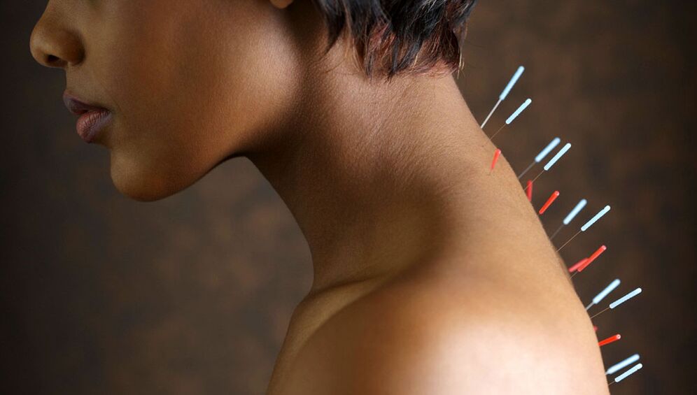 Acupuntura con osteocondrosis cervical
