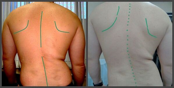 Craumático de la columna con osteocondrosis
