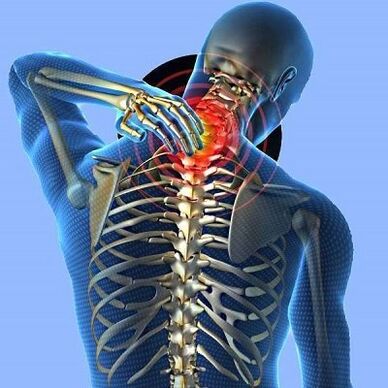 Dolor de cuello con osteocondrosis cervical