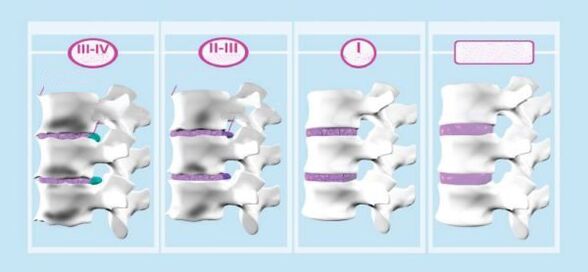 Estadios de osteocondrosis cervical