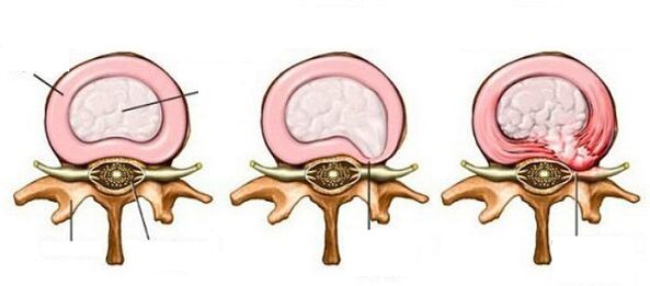 Hernia vertebral intermedia con osteocondrosis cervical