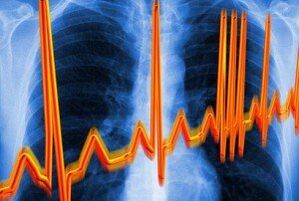 Ritmia cardíaca contra la osteocondrosis