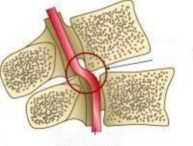 Síndrome de las arterias Vail