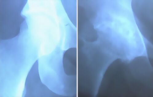 Artrosis espuma de la articulación de la rodilla