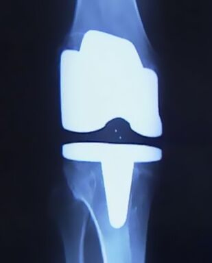 X -Ray Imagen de la rodilla con una prótesis artificial después de la operación para cambiar la articulación