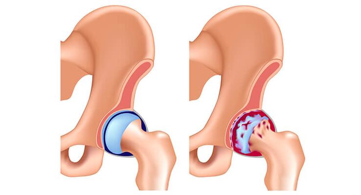 articulación de cadera sana afectada por osteoartritis