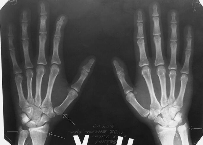 Radiografía para el dolor en las articulaciones de los dedos.
