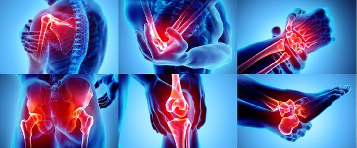 Articulaciones inflamadas