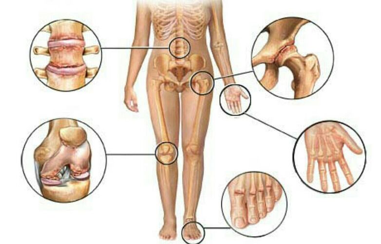 Tipos y grados de osteoartritis