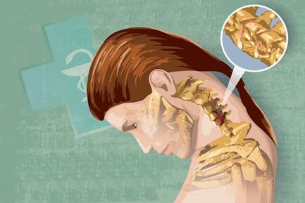 Síntomas reflejos de la osteocondrosis